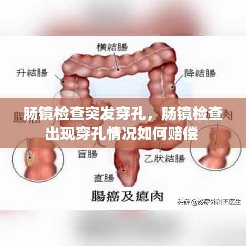 肠镜检查突发穿孔,肠镜检查出现穿孔情况如何赔偿